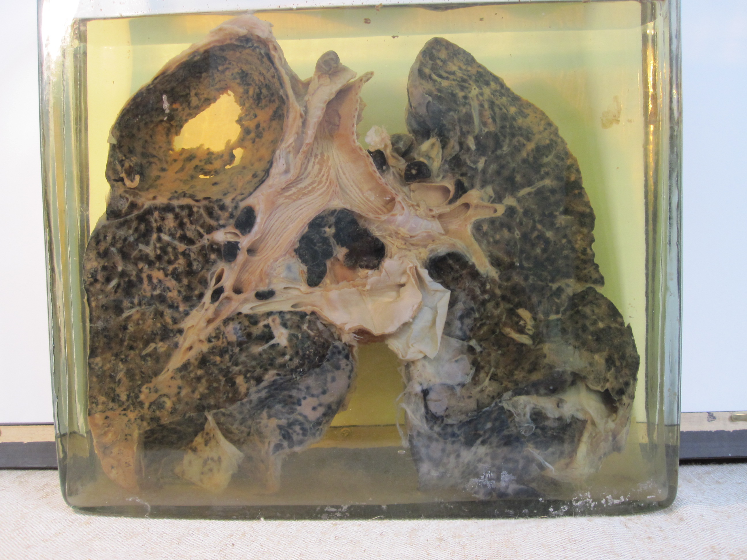 8.-_Miner's_lung_with_silicosis_and_tuberculosis