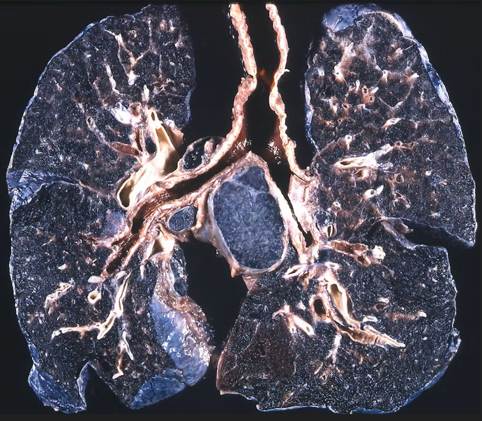 Coal Worker's Lung